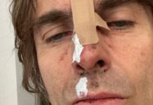 Liam Gallagher pateix un accident d’helicòpter i es trenca el nas