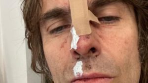 Liam Gallagher pateix un accident d’helicòpter i es trenca el nas